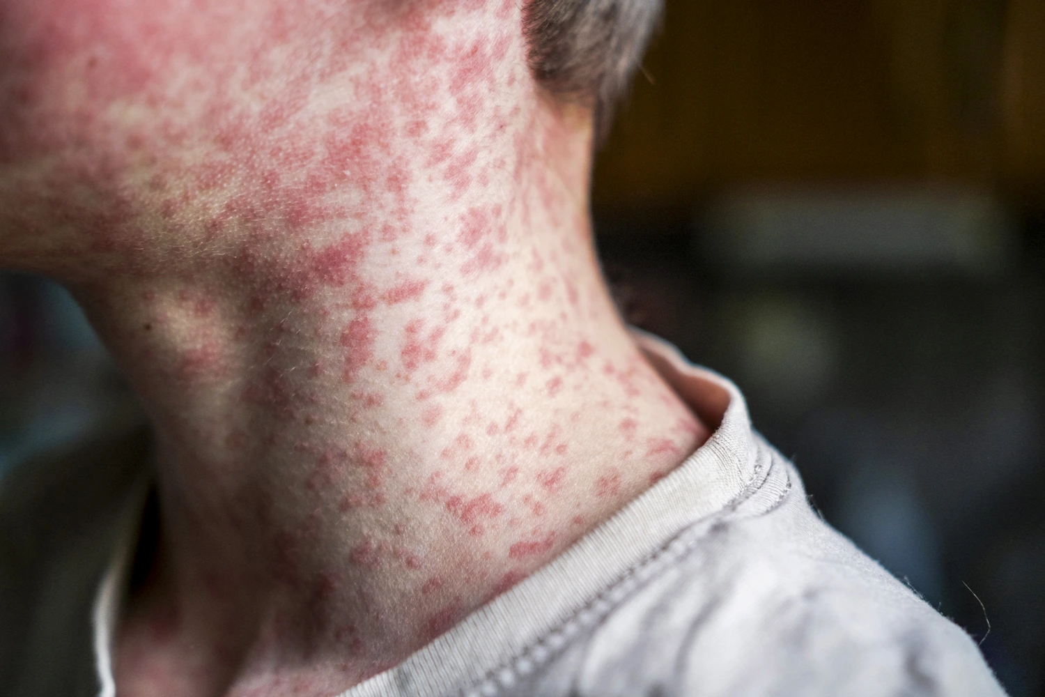Health officials respond to expanding measles outbreak in South Carolina